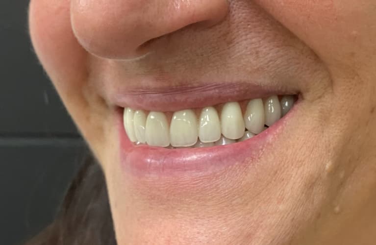 Implantes Dentais