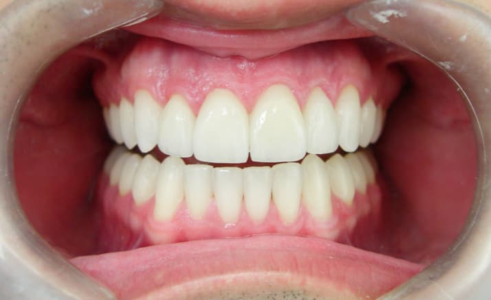 Estética dental com Faceta de Porcelana