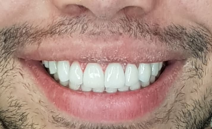Harmonização com Lente de Contato Dental