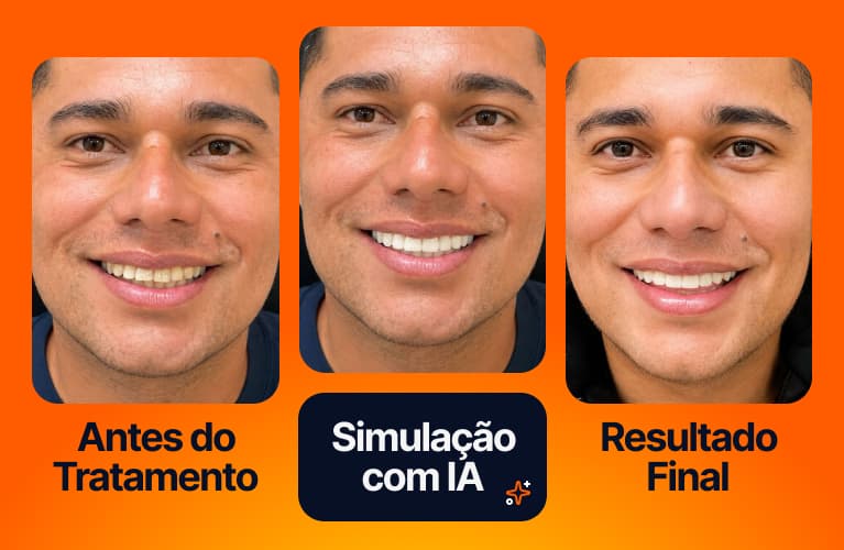 Como ficará meu sorriso com lentes de contato dental? Veja a simulação com IA antes do tratamento